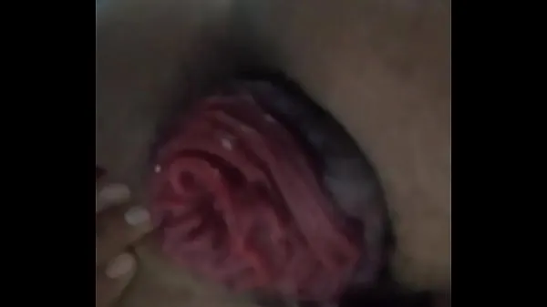 Anal extreme prolapse گرم ٹیوب دکھائیں